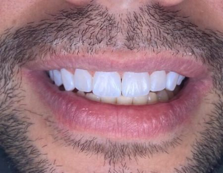 Lente-de-resina-4-e1675345759554